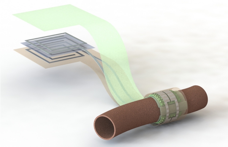 Sensor biodegradvel monitora artrias para evitar novas cirurgias