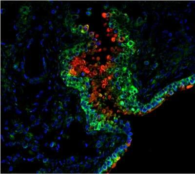 Bactrias do intestino podem prever cncer colorretal