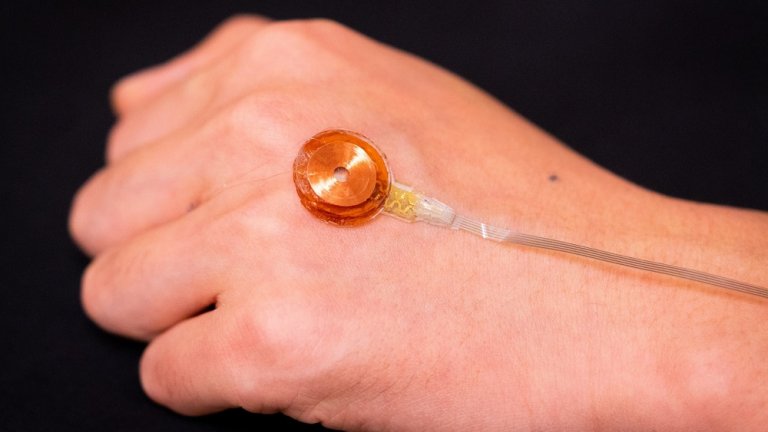 Sensor simples detecta doenas da pele abaixo da superfcie
