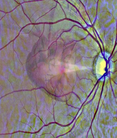 Inteligncia Artificial calcula risco de infarto analisando imagens da retina