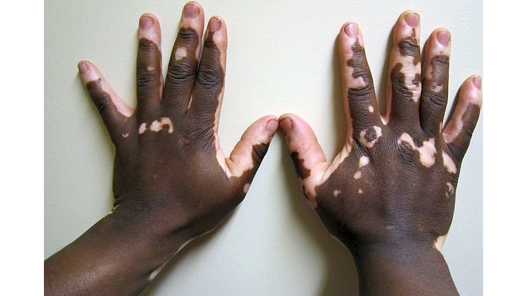 Por que o pigmento nem sempre retorna no vitiligo?