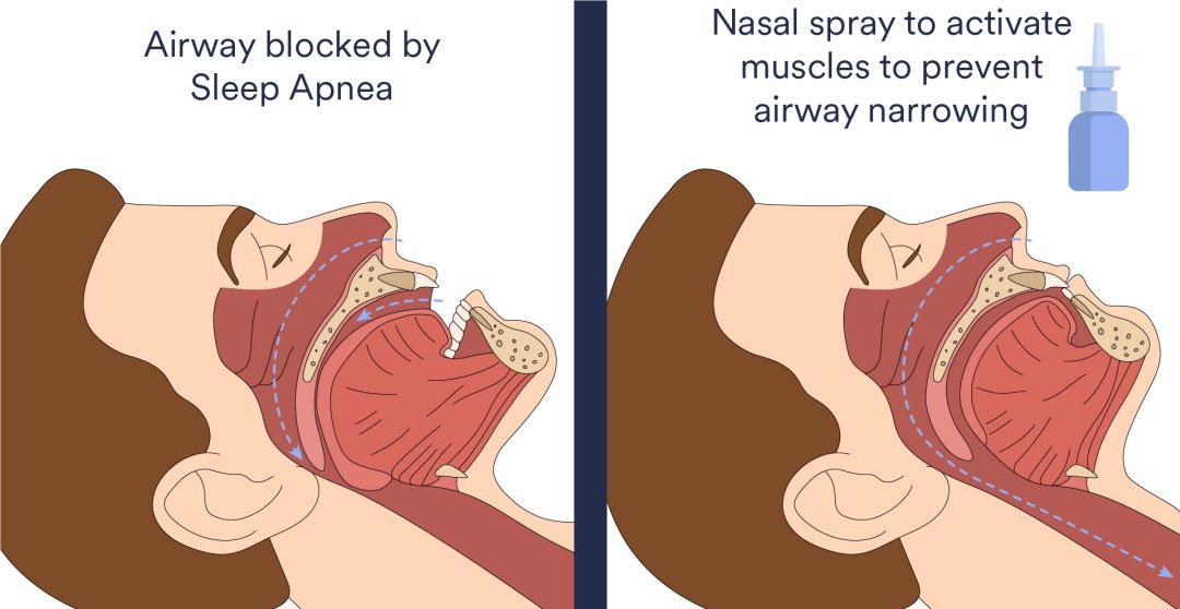 Spray nasal d resultados promissores contra apneia obstrutiva do sono