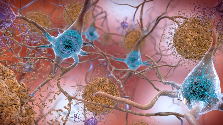 Alzheimer: P-tau indiciada, amiloide sob investigao