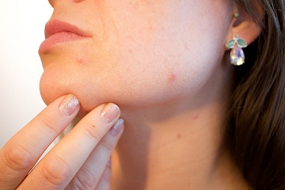 Surge esperana de uma vacina contra acne