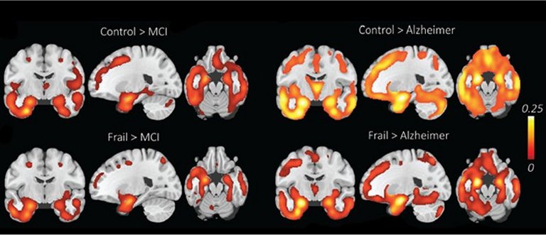 Declnio cognitivo nem sempre  sinal da doena de Alzheimer