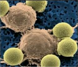 Clulas imunolgicas modificadas geneticamente atacam leucemia