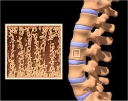 NASA cria exame que detecta osteoporose precocemente