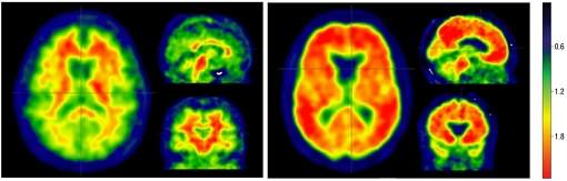 No  apenas amiloide: Alzheimer depende de fator que pode ser prevenido