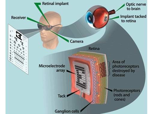 Olho binico  aprovado para uso em pacientes