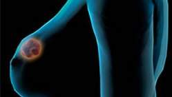 Protenas presentes no cncer de mama podem levar a novos tratamentos
