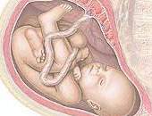 Citoscopia fetal opera bexiga do beb durante a gravidez