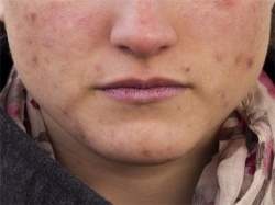 Tratamento natural para acne