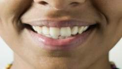 Verniz de titnio pode ser eficaz no combate  eroso dentria
