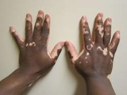 Descoberta suscetibilidade gentica ao vitiligo