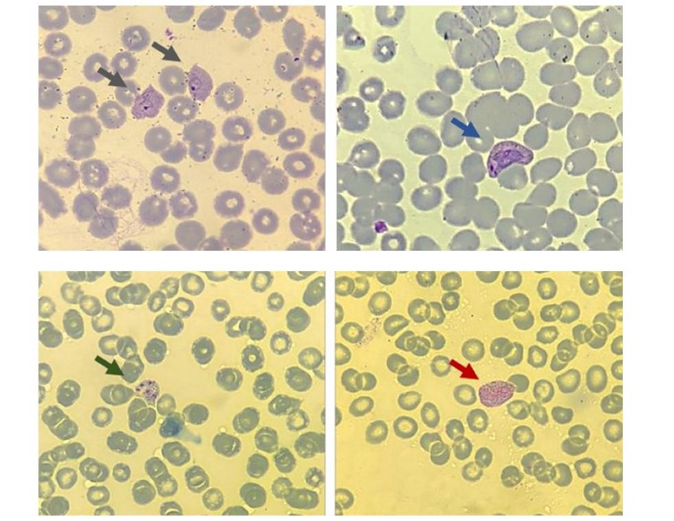 Risco de recada da malria aparece no sangue de pacientes