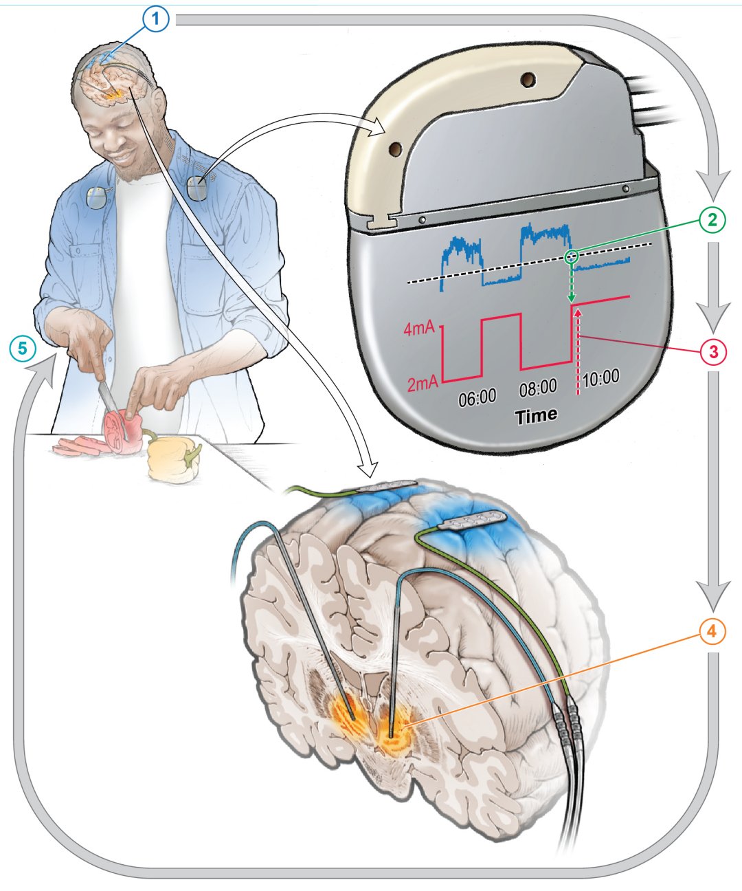 Marcapasso cerebral autoajustvel reduz sintomas da doena de Parkinson