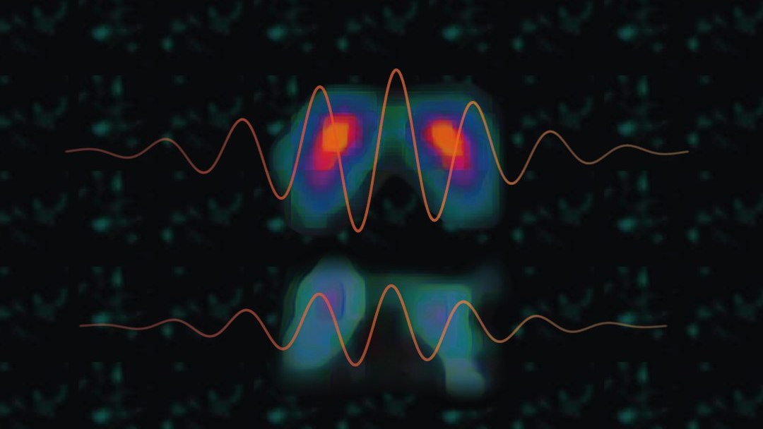 Relao entre dopamina e Parkinson  paradoxal, descobrem cientistas