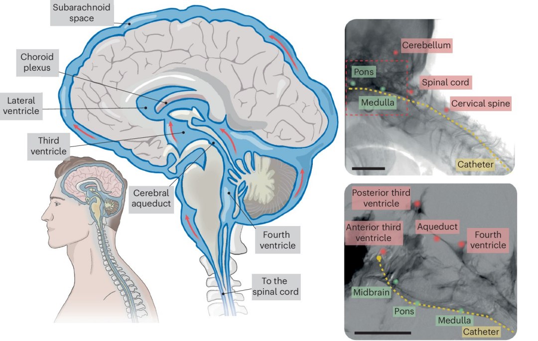 Interface neural minimamente invasiva dispensa abrir o crnio