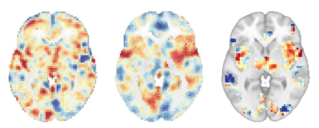 Exames cerebrais comprovam que meditao contra dor no  placebo